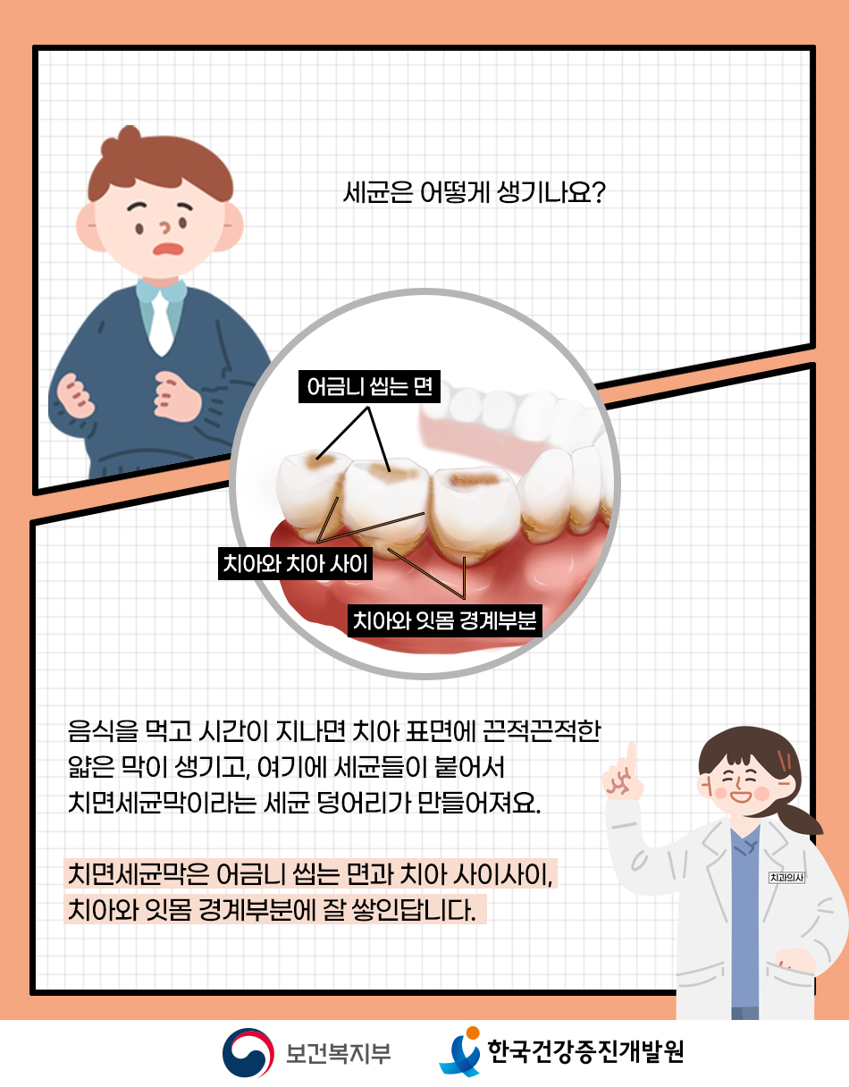 음식을 먹은 후 시간이 지나면 치아 표면에 치면세균막이라는 세균덩어리가 생기고, 이덩어리는 어금니 씹는면과 치아 사이사이, 치아와 잇몸경계부에 잘 쌓임